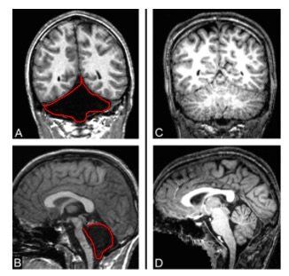 Jonathan's Brain Scan - Missing Cerebellum