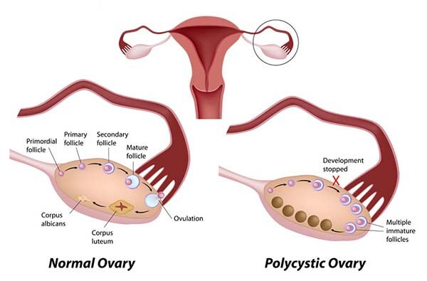pcos